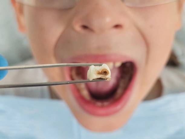 Best Broken or Chipped Tooth Repair in Mosheim, TN